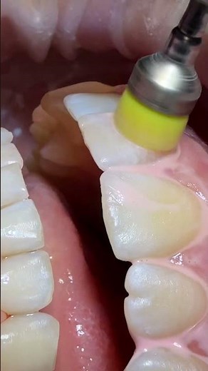 Professional Dental Polishing in Action 🦷✨ #dentalcare #dentist #dentalartistry #satisfying