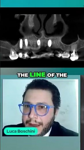 Sinus Lift Simple Bone Grafting Technique for Dental Implants