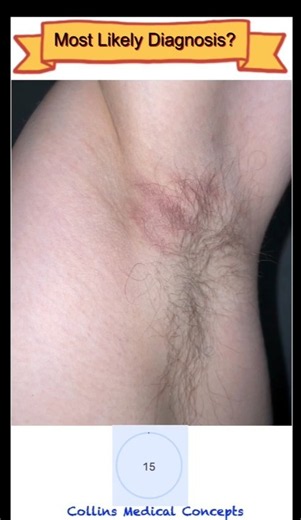 MOST LIKELY DIAGNOSIS #5: Pattern Recognition Challenge | Shiny Rash Under the Armpit #medicalquiz