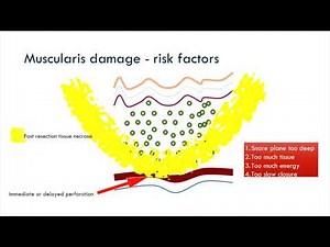 Diathermy in the Colon with John Anderson
