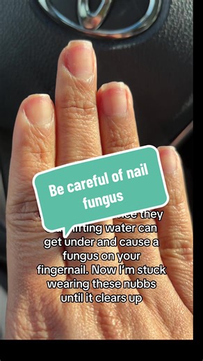Prevent Nail Fungus: Tips for Nail Care
