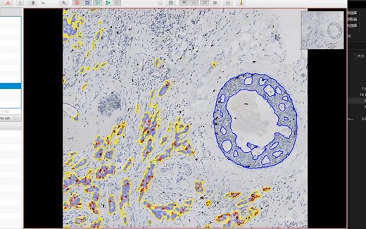 用Qupath批量计算肿瘤区域的Ki-67分数