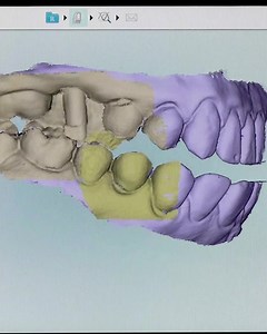 3.7K views · 11 reactions | Want to capture an accurate bite registration for your next digital implant scan? Watch Dr. Taylor Manalili’s how-to video for a more accurate implant restoration next time you digitally restore a case: https://glidewelldental.com/education/dental-video/capturing-an-accurate-digital-bite-registration-for-your-implant-restoration | Glidewell Dental | Facebook