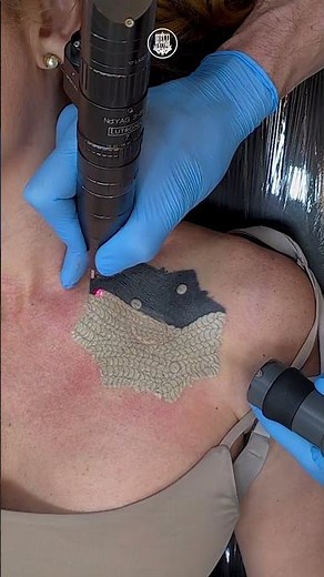 Início da remoção de tatuagem extremamente pigmentada no colo | Remoção de Tatuagem