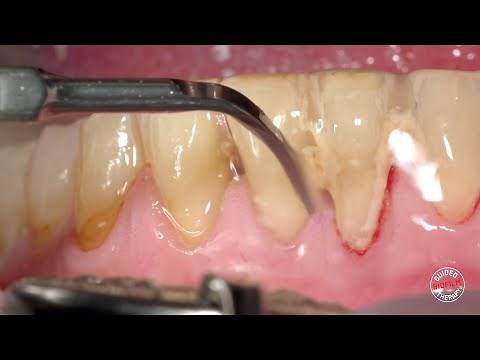 Gingivite & GBT - Guided Biofilm Therapy