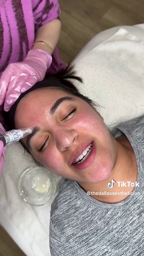 SkinPen Microneedling: Before & After Treatment