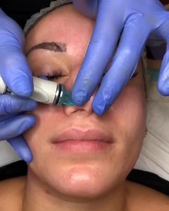 Hydrafacial Results