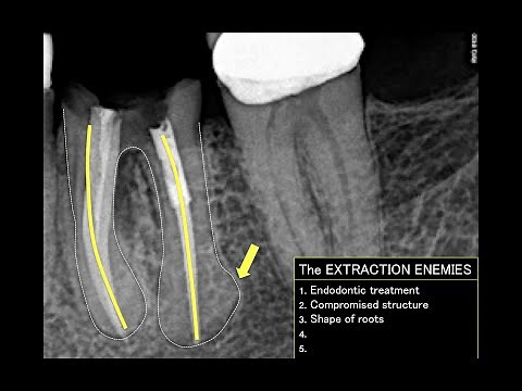 How to extract a lower molar (PART 1)