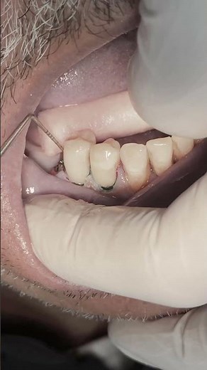 Class V composite restoration for lower first & second premolar teeth 🦷 #dentist