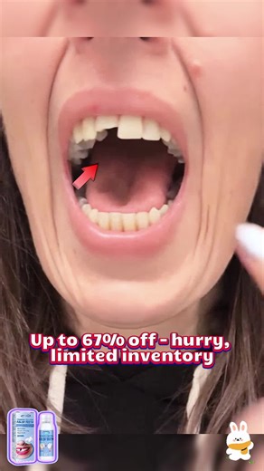 Watch me make a fake tooth — comment if you want the steps. #dentures #faketeeth #thermal #teethreplacement #moldablefalseteeth