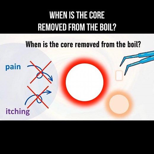 When is the core removed from the boil? #furuncle #boil #skininfection #boils
