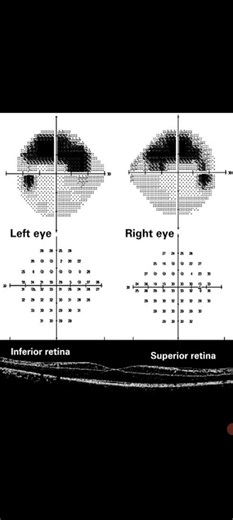 Altitudinal Visual Field Defect( Arcuate Scotoma) grass Awerenes of All grass images of Eye 👁‍🗨
