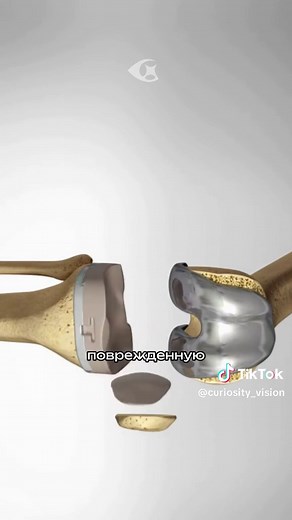 Total Knee Replacement Procedure Explained
