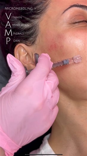 Fix Me Up Medical Spa on Instagram: "What is VAMP? VAMP by Revanesse is a topical, sterile bio-revitalizing solution used for skin rejuvenation. It's a serum enriched with vitamins, amino acids, minerals, and PDRN (Polydeoxyribonucleotide), derived from salmon DNA 📱Visit fixmeupmedspa.com or call us at (818) 238-9850 to book an appt 📍 2407 W Burbank Blvd. Burbank, CA 91506 📍 20072 SW Birch St. STE 160 Newport Beach, CA 92660 . SERVICES: - Facial balancing ( multiple syringes) - Nose Filler ( 