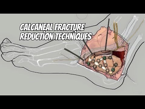 Calcaneal Fracture Reduction Techniques: The Ways to Fix a Broken Heel