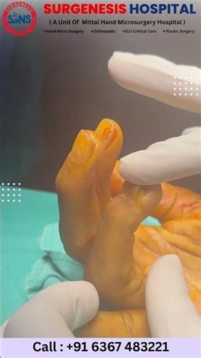 Sergenesis Hospital: Hand regains function from a jammed finger