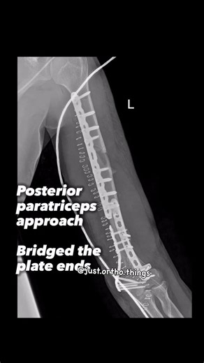 Ipsilateral shaft humerus with a distal humerus fracture