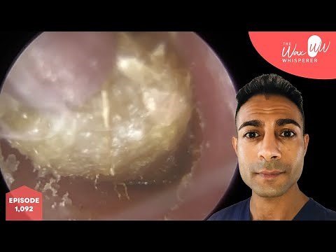 1,092 - Fully Blocked Ear Wax & Dead Skin Removal
