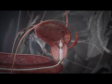 Normal BPH and Catheter Treatment for Prostate Cancer