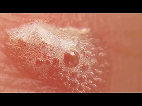 Disinfect wound with Hydrogen peroxide