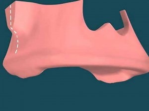 Dental Video of Maxillary Tuberosity Removal