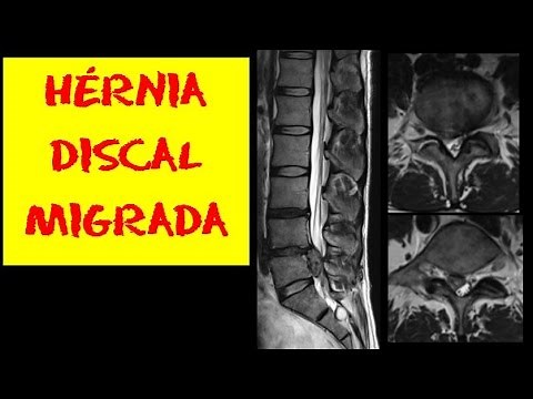 Magnetic resonance imaging of the lumbar spine: Migrated disc herniation