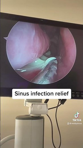 Sinus infection relief - suctioning pus provides immediate relief during an acute sinus infection