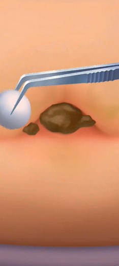 Most Extreme Pimple Clean Ever… Are You Ready? 😳🔥 #asmranimation #satisfyingvideo #oddlysatisfying #pimplepopping #extractionasmr #cleaninganimation #viralreels #trendingnow #satisfyingasmr #animationvideo #relaxingvideos #reels2025 #explorepage | ASMR