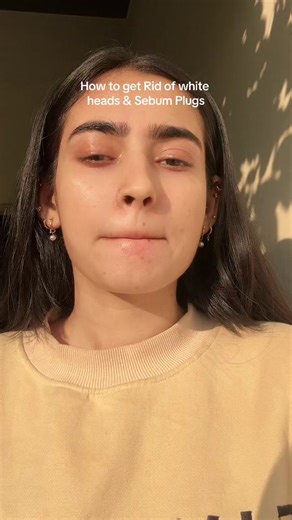 Effective Azelaic Acid Treatment for Whiteheads