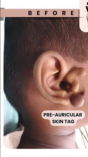 SAFE Ear Tag Removal | Easy Steps to Remove Pre-Auricular #skintags #skintagsremoval #shorts