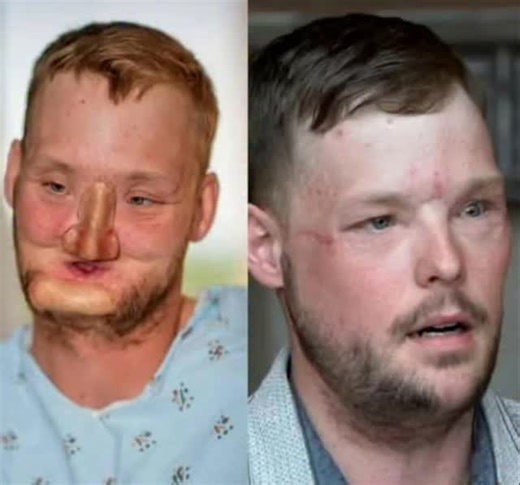 In 2006, Andy Sandness from Wyoming was just 21 when a devastating accident forever changed his life. His face was shattered, his identity nearly erased. What followed were years of unimaginable pain — eating, speaking, even smiling became near-impossible tasks. Behind every glance in the mirror was a memory of what once was, and what might never be again. For a decade, Andy lived in quiet resilience. Countless reconstructive surgeries, facial prosthetics, and moments of despair — yet he refused