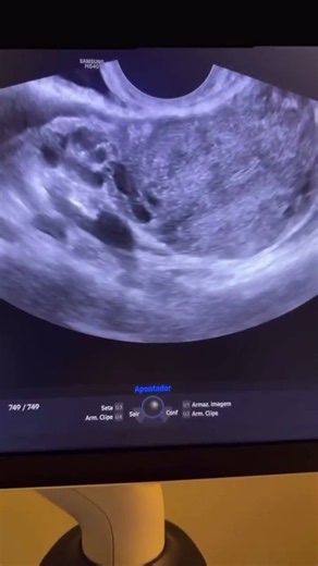 Ela veio fazer um ultrassom transvaginal de rotina