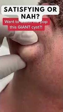 Removing large blackheads and pimples from face new 2026 #180