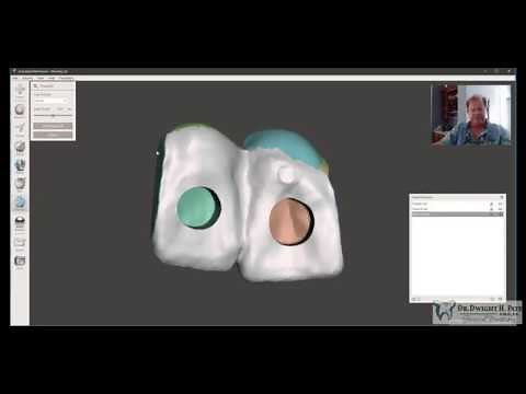 Essix Retainer with Fake tooth