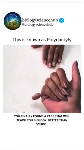 BIOLOGY UNIVERSE on Instagram: "Polydactyly is a condition where a person is born with extra fingers or toes. While it may look unusual at first glance, it’s simply a variation in human development and has been present throughout history and across cultures. Some people are born with an extra digit on their hand, some on their foot, and others on both. For many, polydactyly doesn’t cause pain or limit daily life at all — it’s just part of what makes them unique. In some cases, the extra digit is