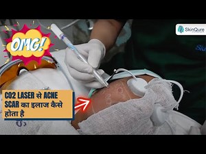 CO2 Laser for Acne Scar Removal - Explained by Dr Jangid | SkinQure | Dr. Jangid
