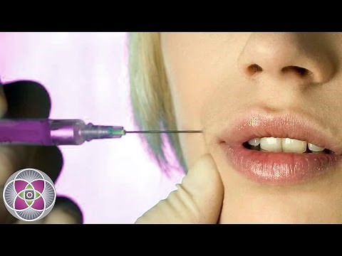 Before and After Facial Contouring with Dermal Fillers