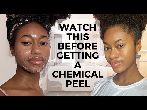CHEMICAL PEEL FULL PROCESS | BEFORE & AFTER | JOURNEY TO CLEAR SKIN