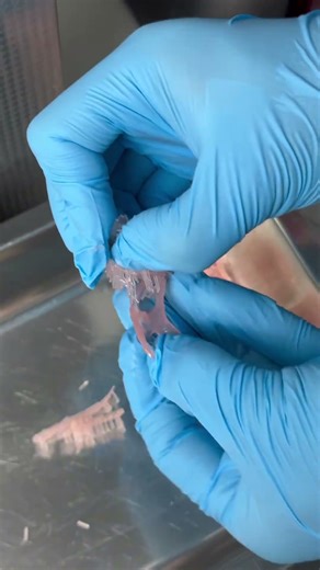 3D printed flexible denture—simplify your dental workflow!