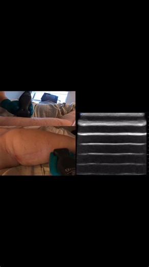 TheVascularGuy on Instagram: "USGPIV - Junction Theory Portrait 06.mp4 The objective of this technique is to increase hemodilution by taking advantage of the body's natural flow rate and flow path. hemodilution is one of the major factors in reducing glycocalyx erosion from non-homeostatic fluids infused into the patient by nurses and doctors. Equipment Used: @butterflynetwork iq+"