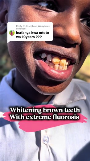 Replying to @Josephine_Wanyama quick teeth whitening #teethwhitening #dental#fyp