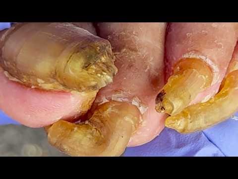 68 Year Old Man's Toenails Are Thick And Long, Wonderful Pedicure Video【Pedicure King】