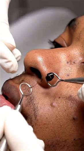 “Deep Pore Explosion! Massive Blackheads Removed"