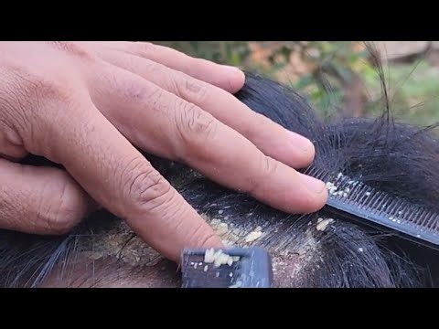 ASMR Scalp Scratching for Sleep and Relaxing Care #800