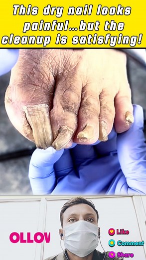 💯🟥💯“This dry nail looks painful… but the cleanup is satisfying!”✅😮✅ . . . #DryNail #DryNailCare #NailCleaning #NailCutting #ToenailCare #PedicureAtHome #SatisfyingVideo #NailTransformation #FootCare | Manicure Pedicure At Home
