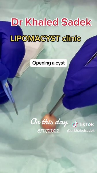 Exploring the Contents of an Epidermoid Cyst