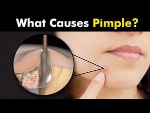 Why do we get Pimples?