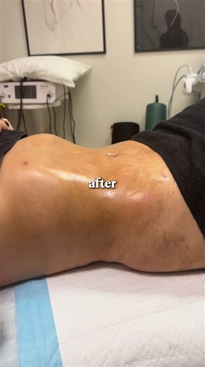 Before ➡️ After Lymphatic post-op massages are a key part of the healing process after awake lipo. In the early stages, it’s common to experience tightness, firmness, and that “clenched” feeling as the body recovers. With consistent lymphatic support, we help encourage fluid movement, soften tissue, and support smoother healing, allowing her shape to gradually come through the way it’s meant to 🤍 Healing is a process and this is why post-op care matters. #beautysculptaesthetics #postop #postopl