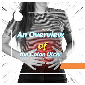 3.4K views · 74 reactions | An Overview of the Colon Ulcer. Certain conditions and disorders are so commonplace that even thought they are fairly serious, people do not panic over them since these conditions and disorders are something people having a working familiarity. This eliminates the fear of the unknown induced stress that a lack of familiarity might breed. | All about health and nutrition | Facebook