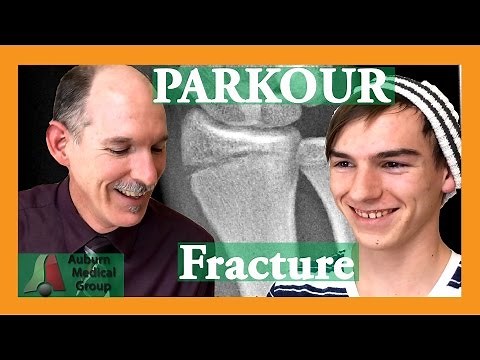 Parkour Broken Wrist | Auburn Medical Group